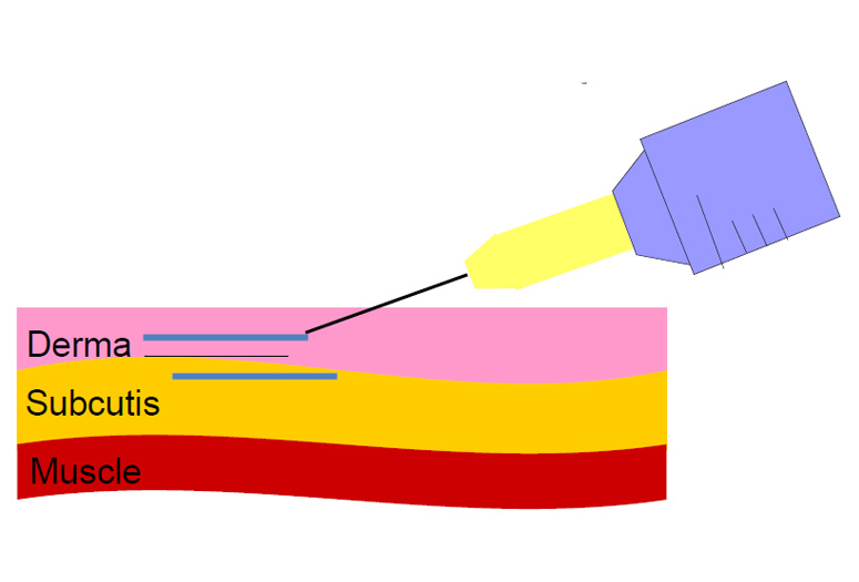 Linear antegrade technique