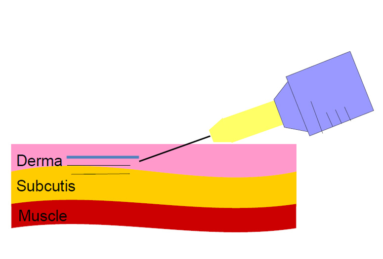 Linear anterior retrograde technique