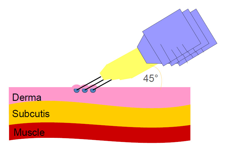 Point technique